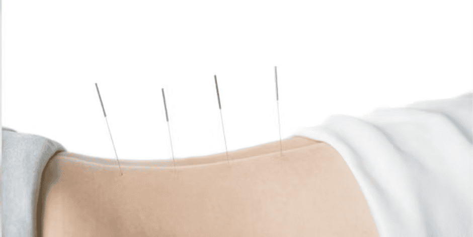 Fine acupuncture needles on a person’s back in a wellness setting.