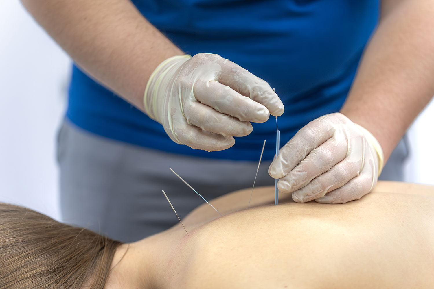 Practitioner inserting acupuncture needles into a patient's back.